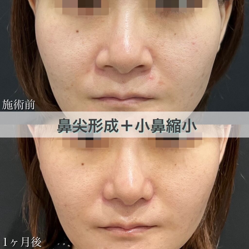 小鼻縮小切開法・鼻尖形成