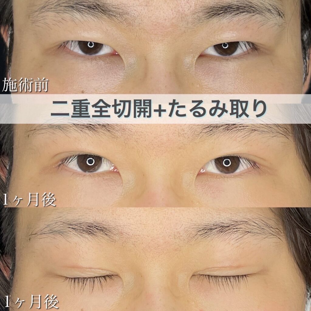 二重全切開＋たるみ取りの症例