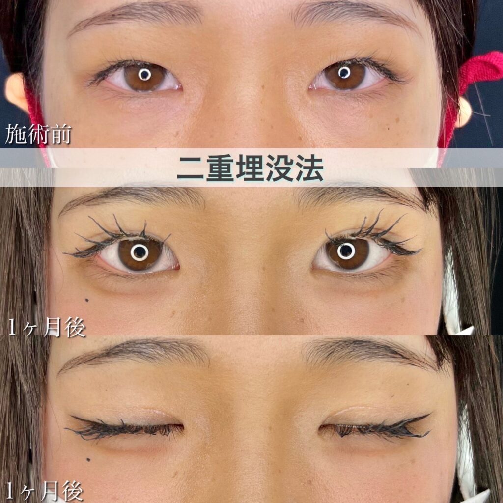 二重埋没法　自然癒着法の症例
