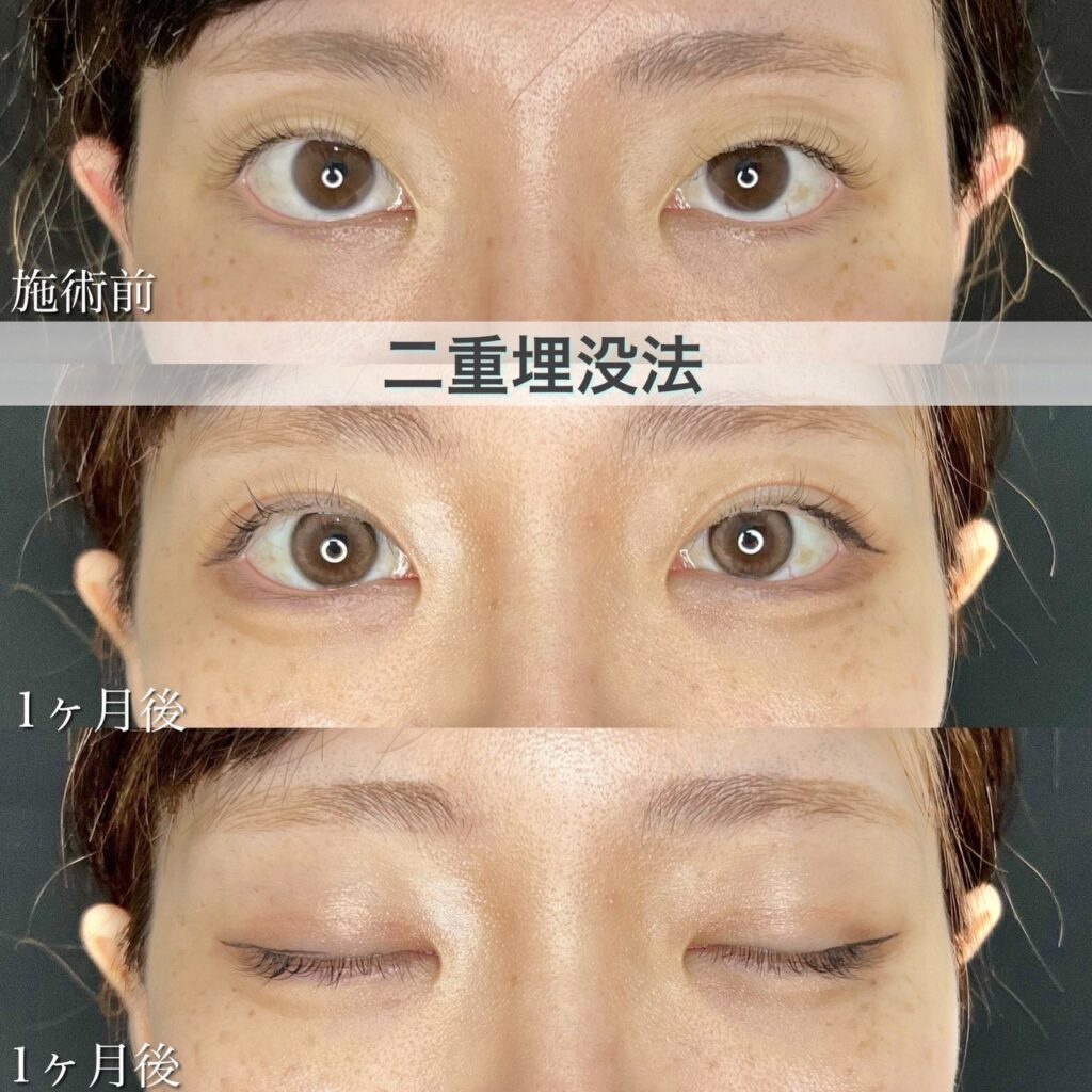 二重埋没法　自然癒着法の症例