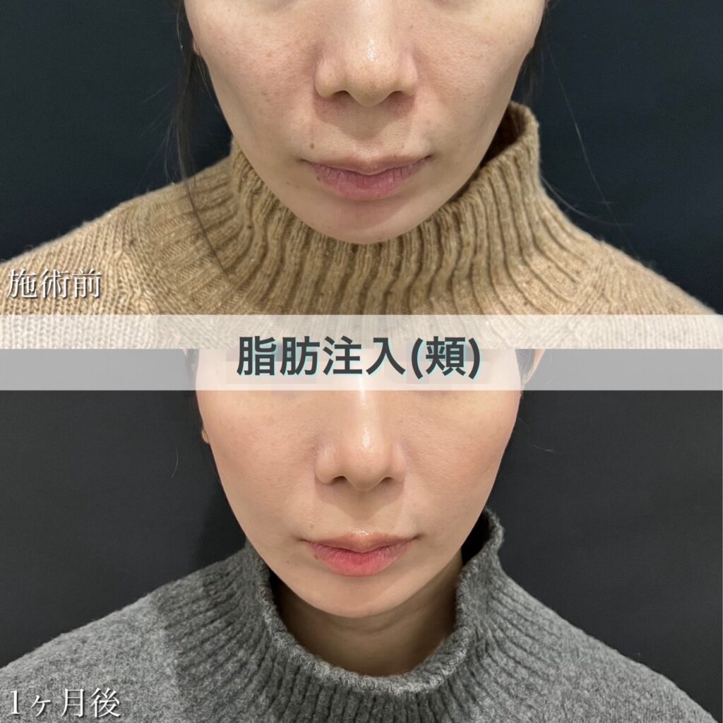 脂肪注入【頬】