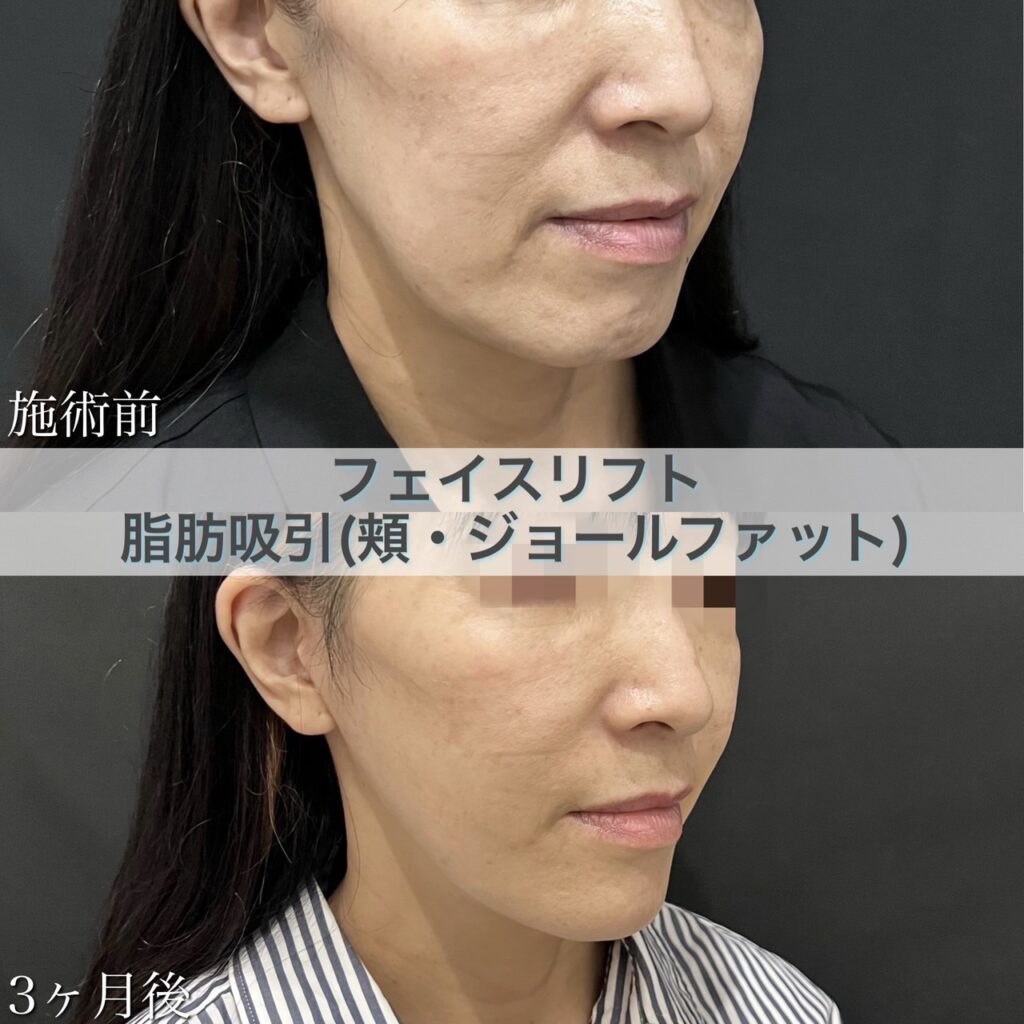 切開リフト・脂肪吸引【頬・ジョール】