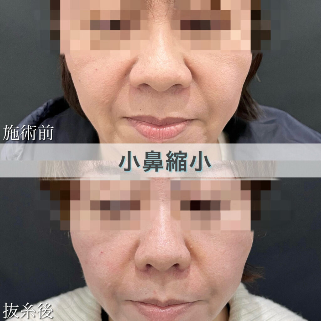 小鼻縮小切開法の症例