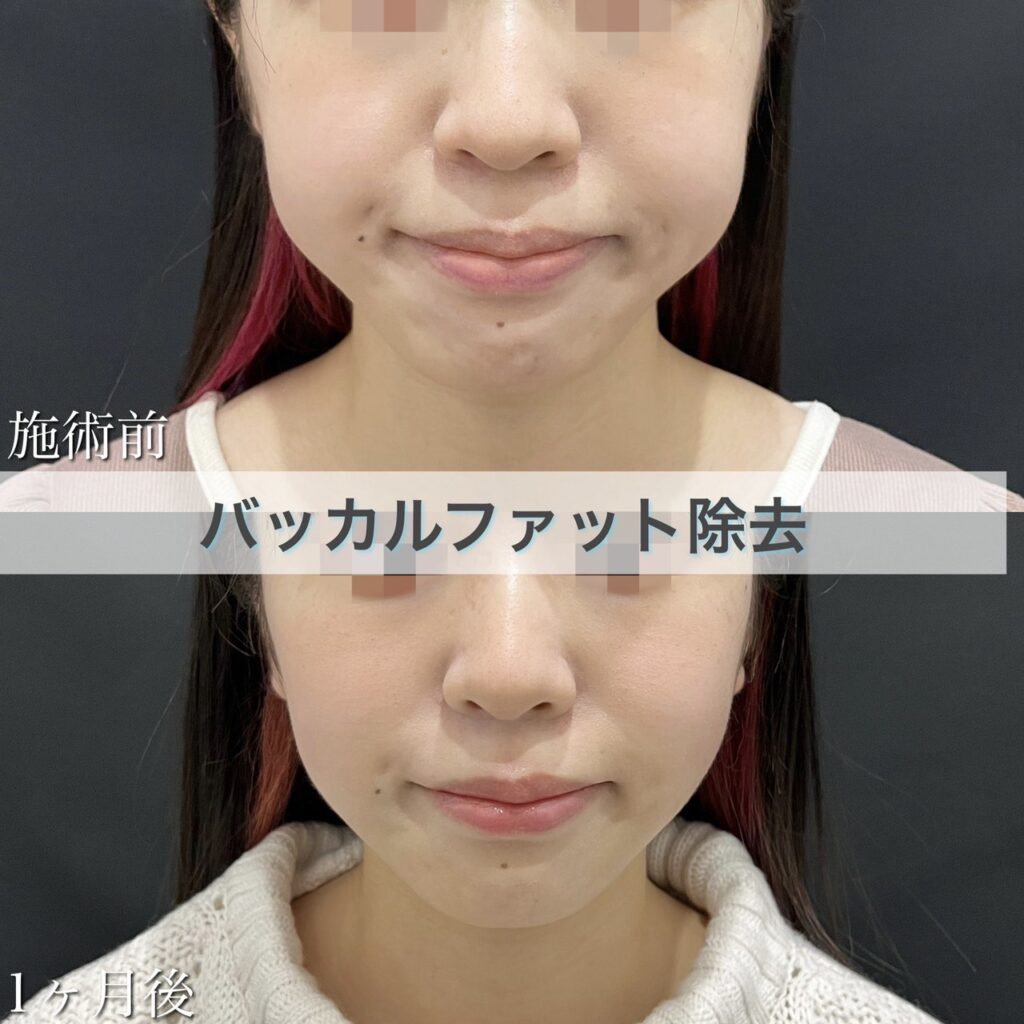 脂肪吸引【バッカル】