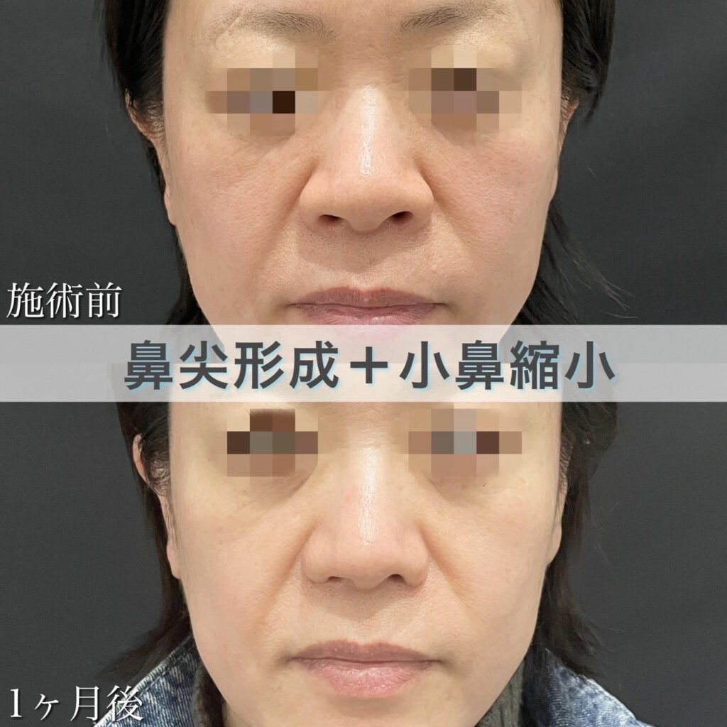 鼻尖形成＋小鼻縮小