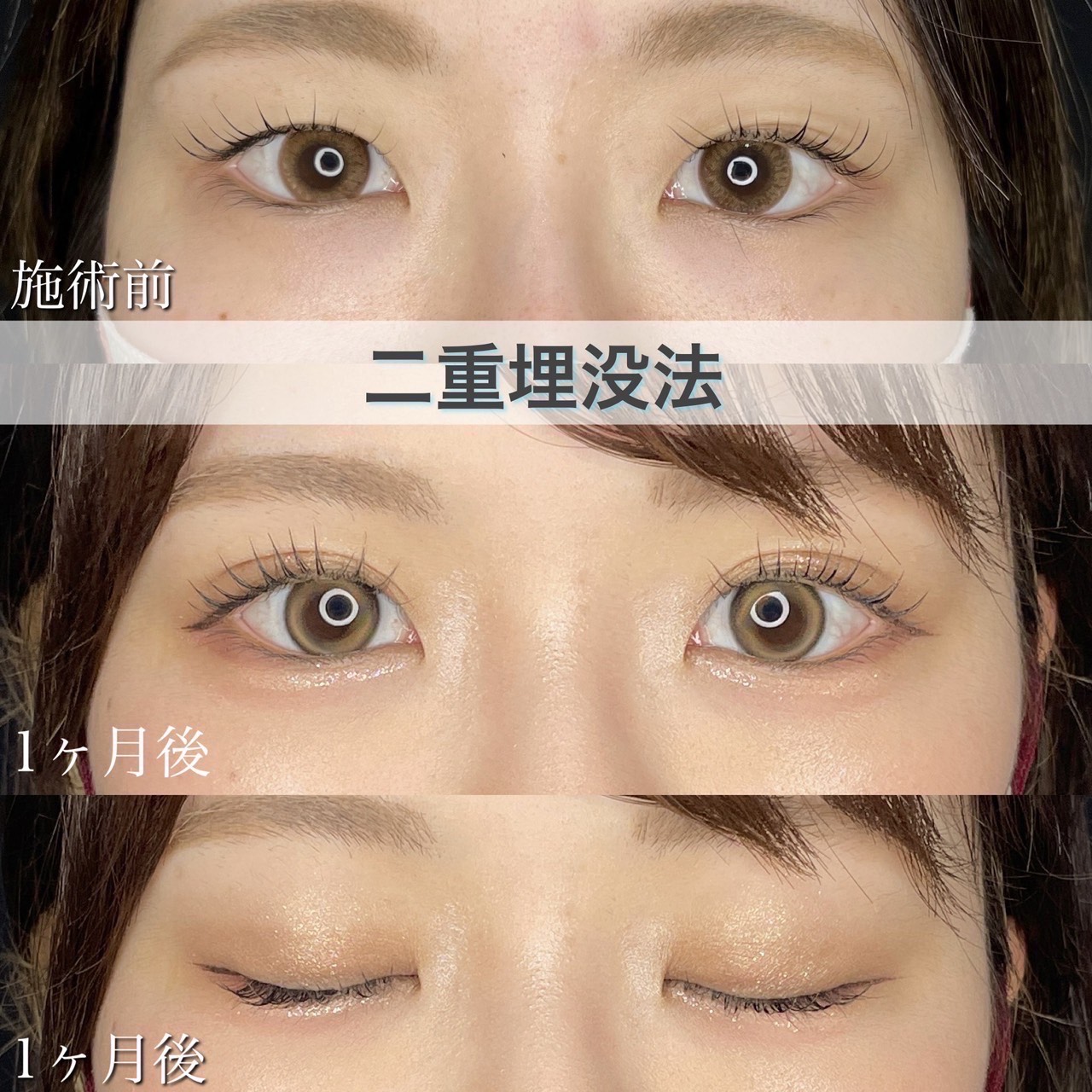 二重埋没法　自然癒着法の症例