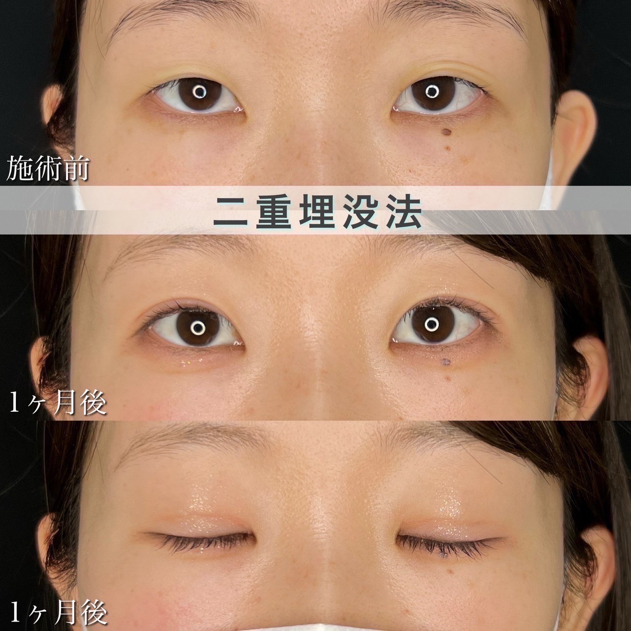 二重埋没法　自然癒着法の症例