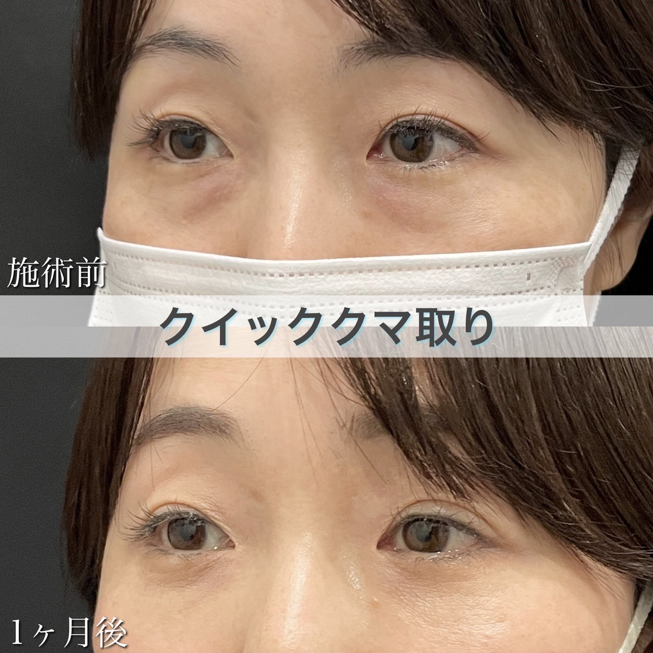 クマ取り（目の下の脂肪取り）の症例