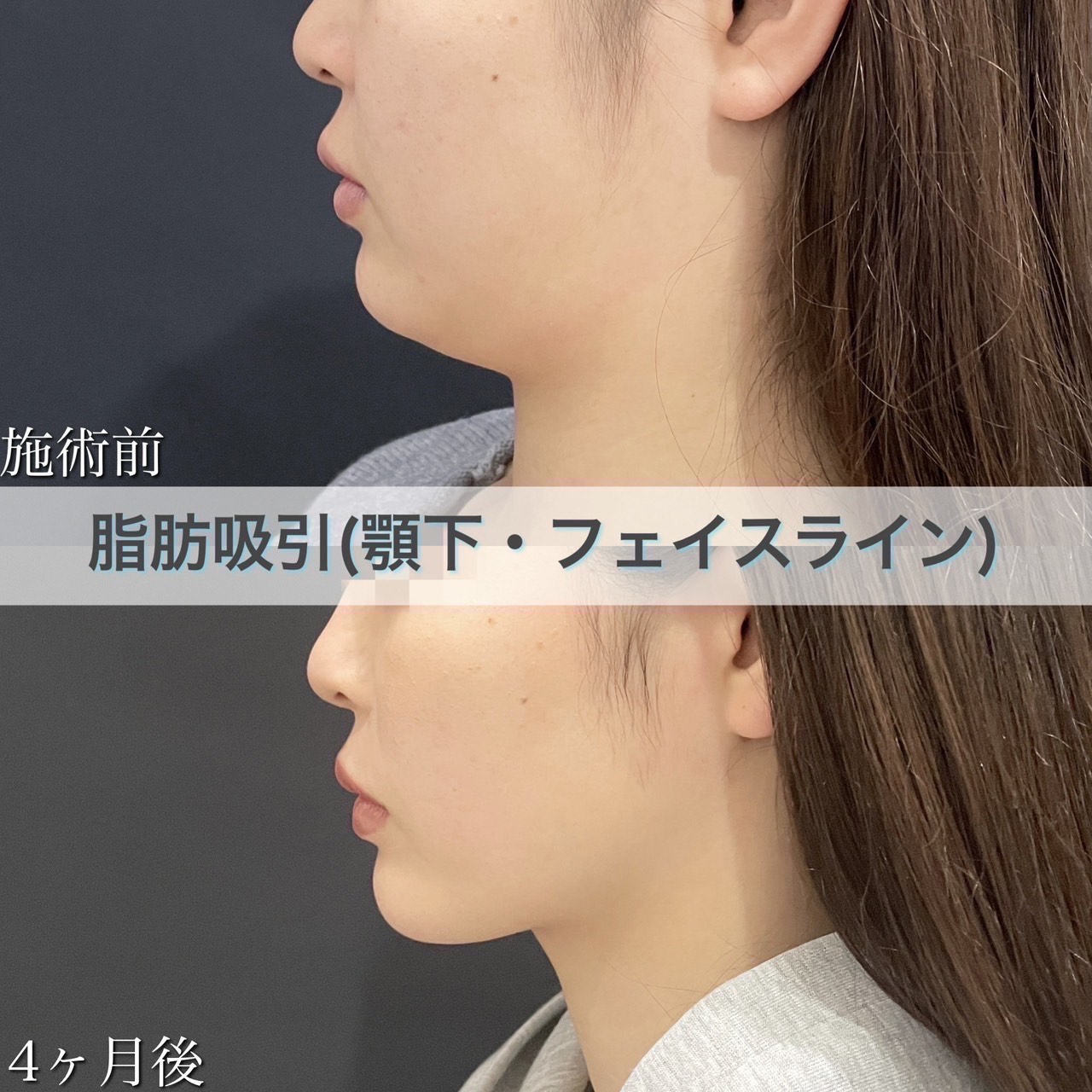 脂肪吸引の症例