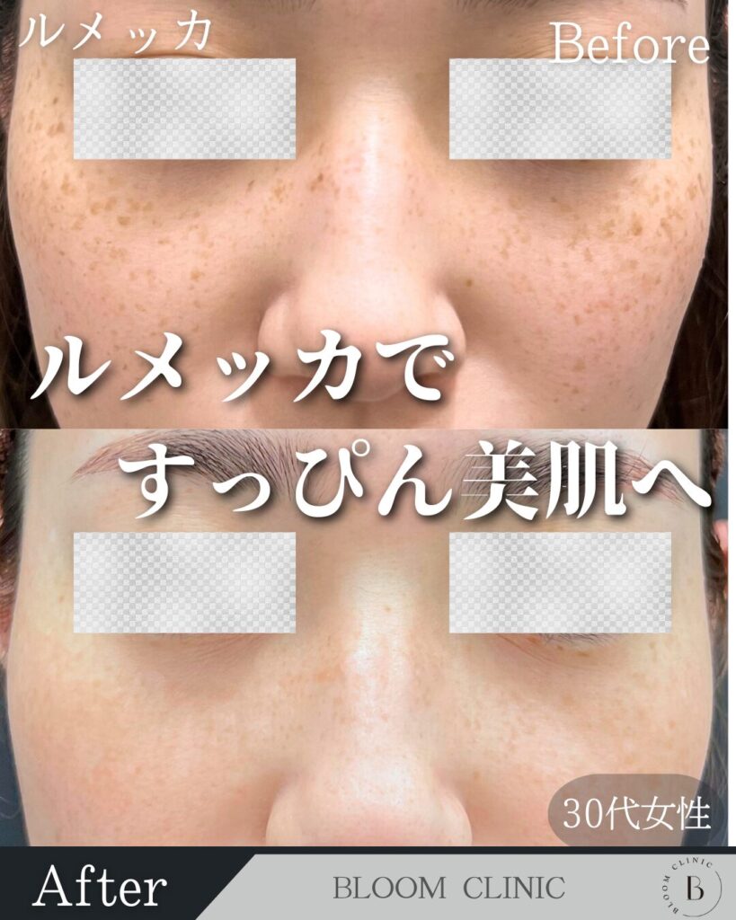ルメッカの症例