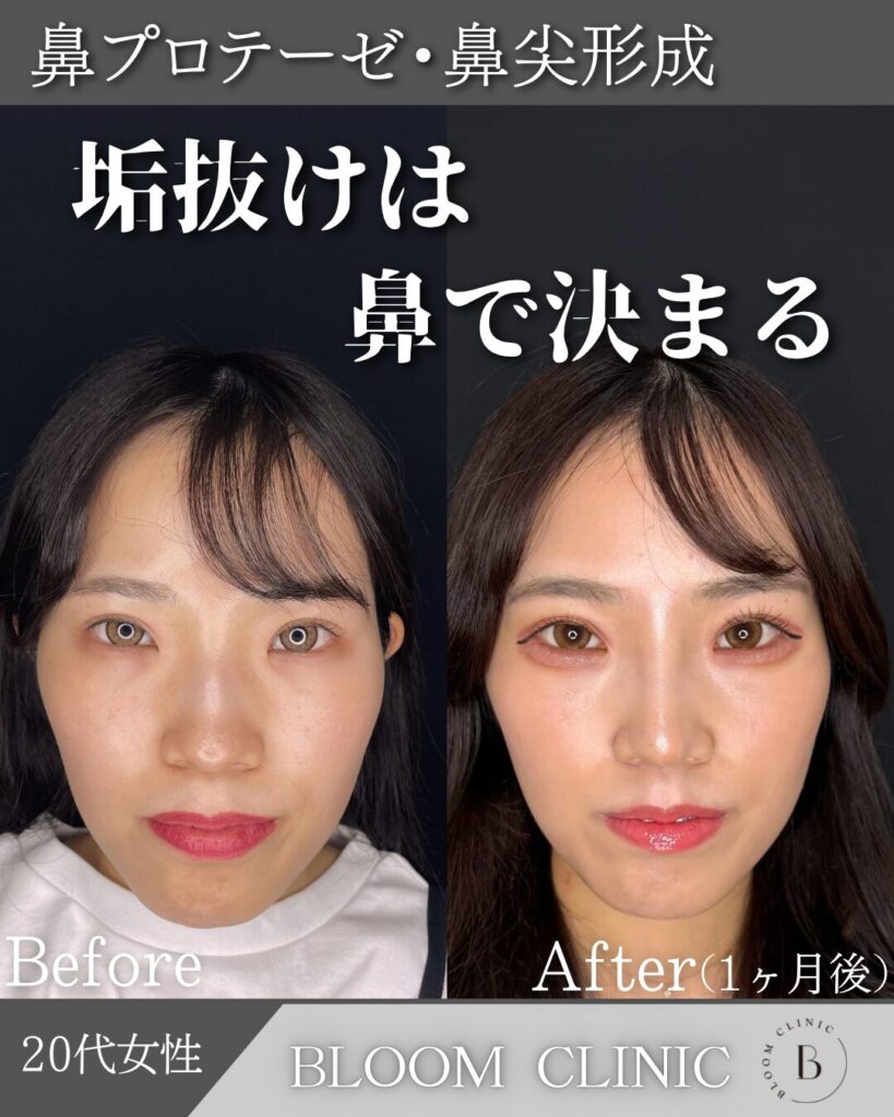隆鼻術（プロテーゼ）・鼻尖形成 の症例