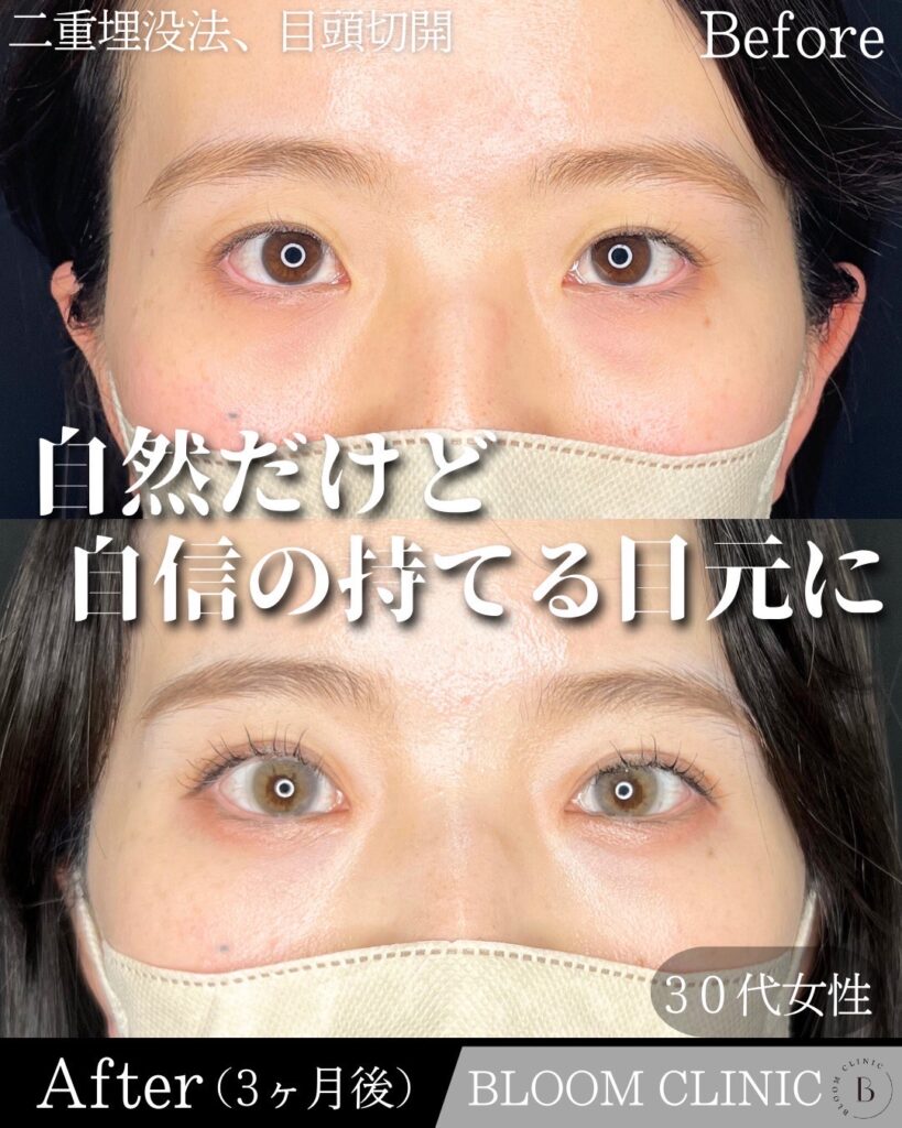 二重埋没法　自然癒着法・目頭切開の症例