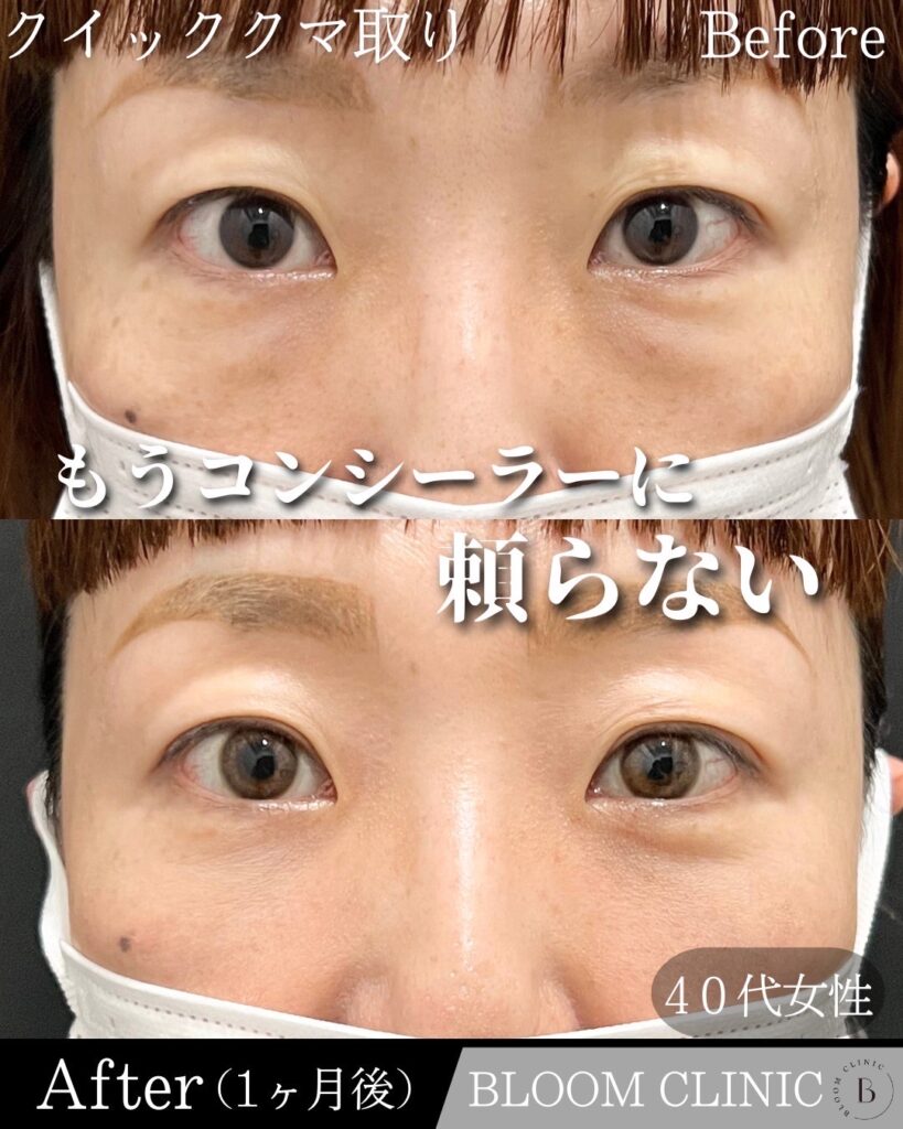 クマ取り（目の下の脂肪取り）の症例