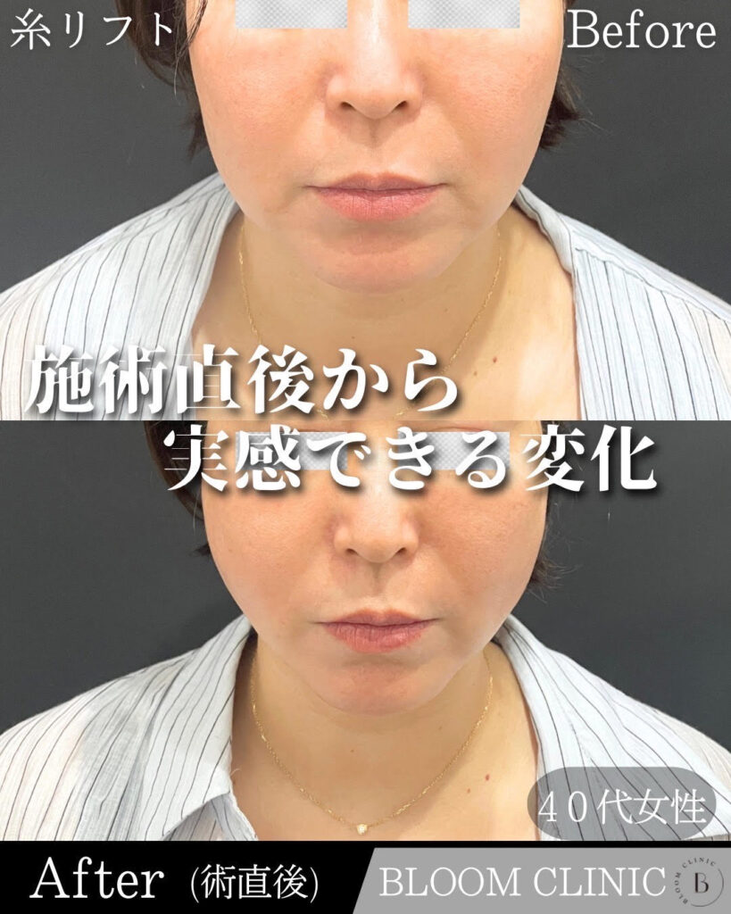 BLOOM　THREAD（糸リフト）の症例