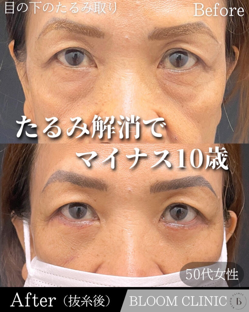 目の下のたるみ取り(脂肪除去併用)の症例