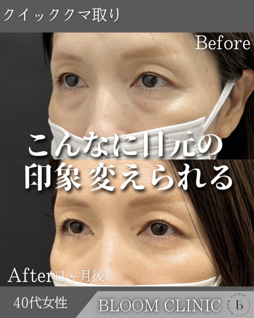 クマ取り（目の下の脂肪取り）の症例