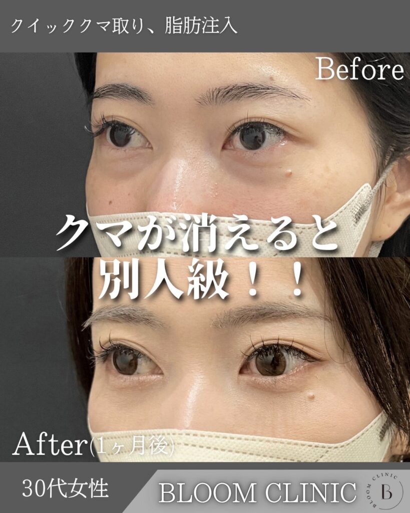 クマ取り+脂肪注入の症例