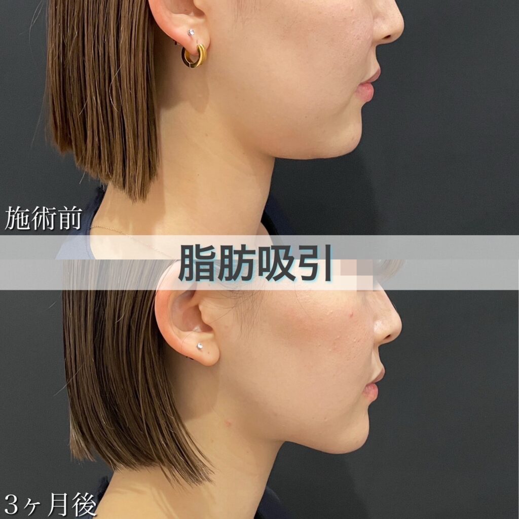 脂肪吸引の症例