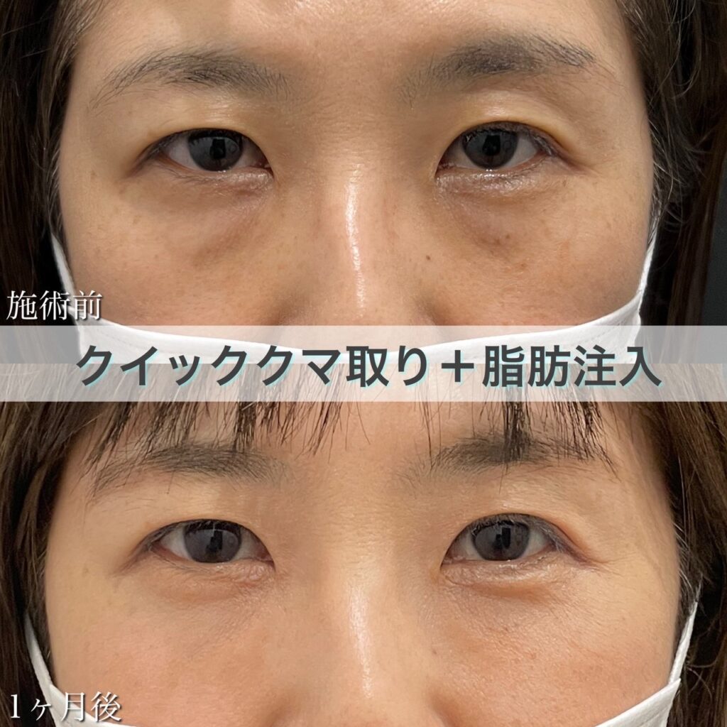 クマ取り+脂肪注入の症例