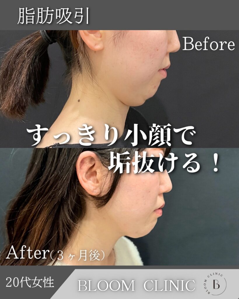 脂肪吸引の症例