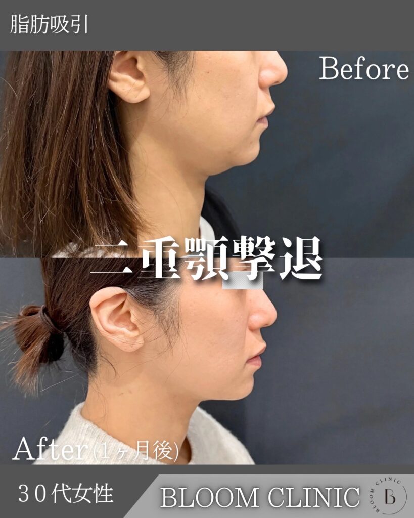 脂肪吸引の症例