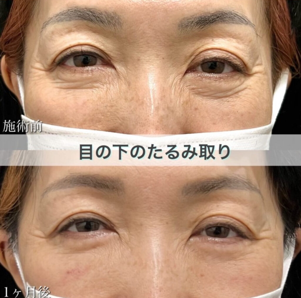目の下のたるみ取り(脂肪除去併用)の症例