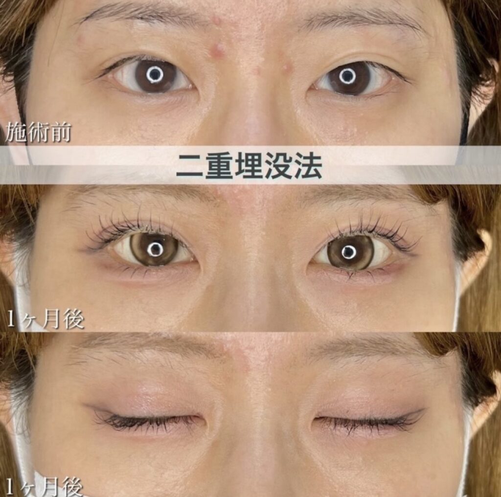 二重埋没法　自然癒着法の症例