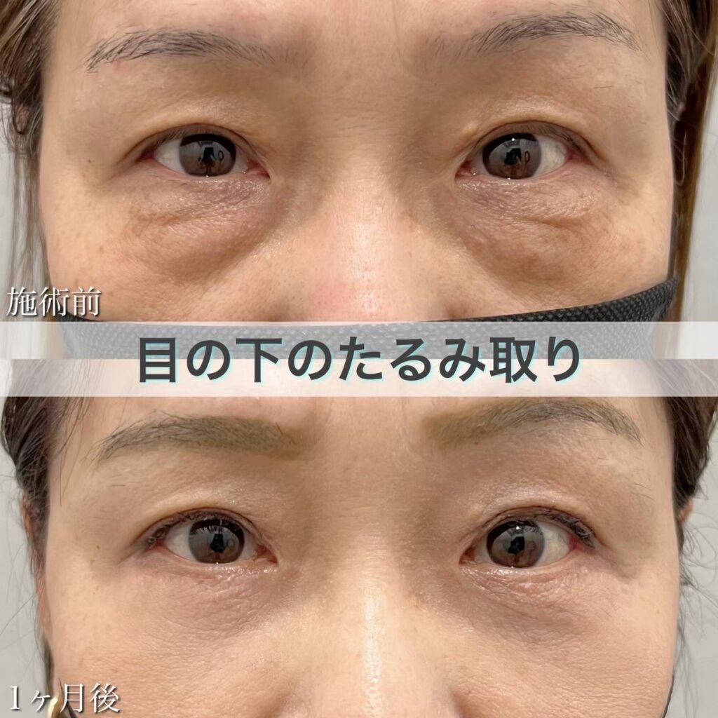 目の下のたるみ取り(脂肪除去併用)の症例