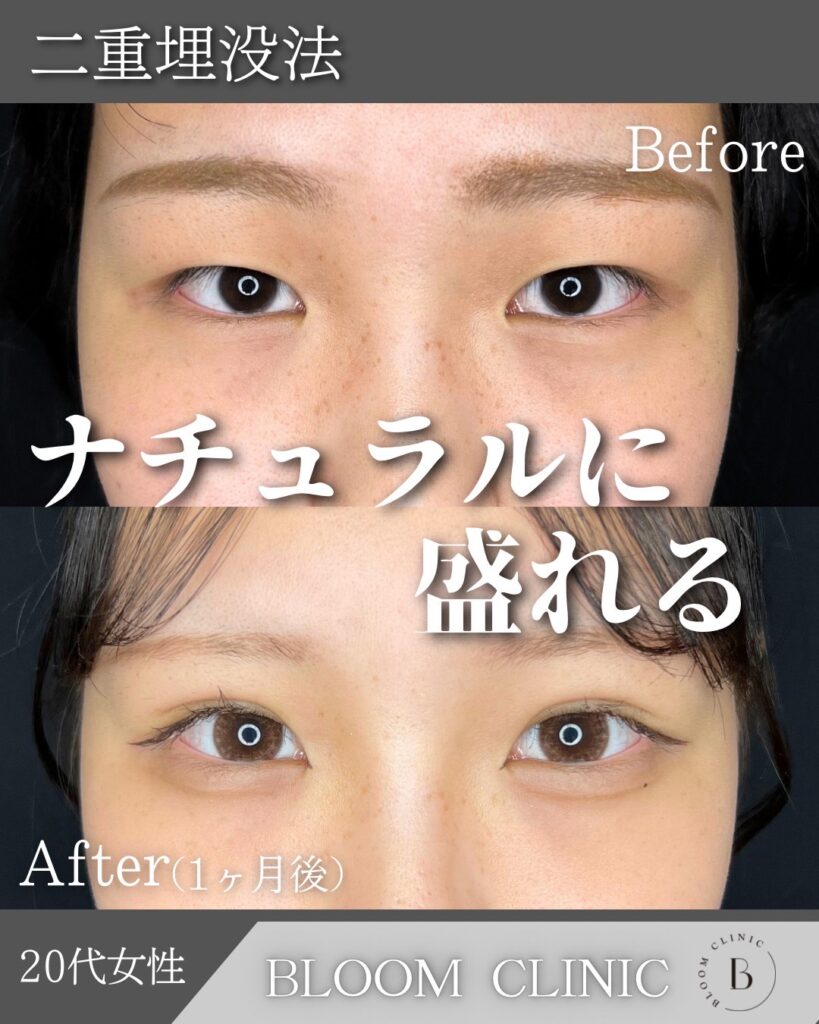 二重埋没法　自然癒着法の症例