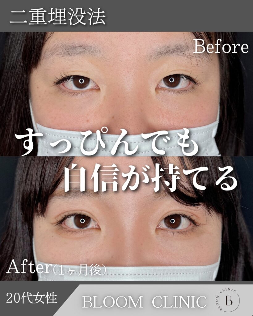 二重埋没法　自然癒着法の症例