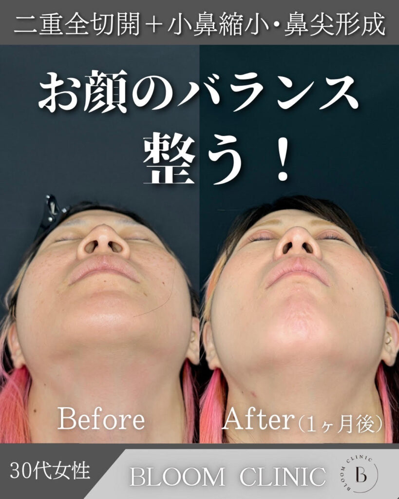 鼻尖形成・小鼻縮小切開法の症例
