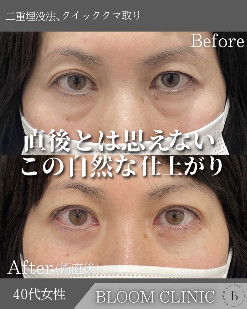 クマ取り（目の下の脂肪取り）・二重埋没法の症例【PICK UP】
