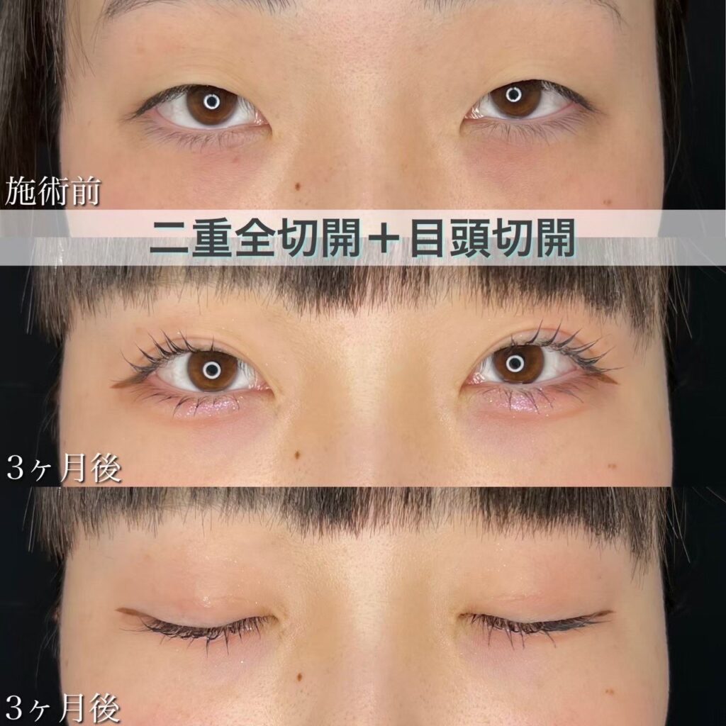 二重全切開・目頭切開の症例