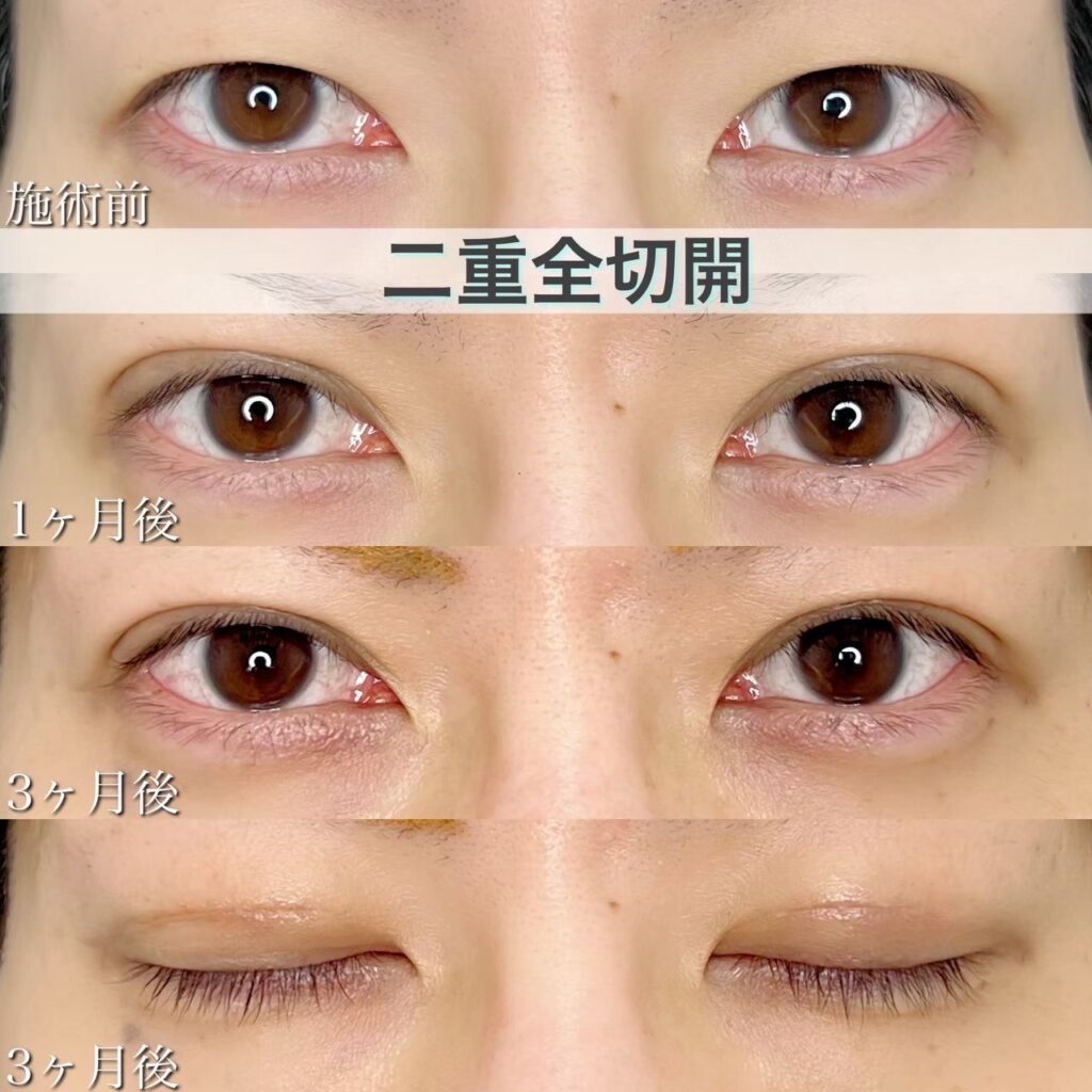 二重全切開の症例