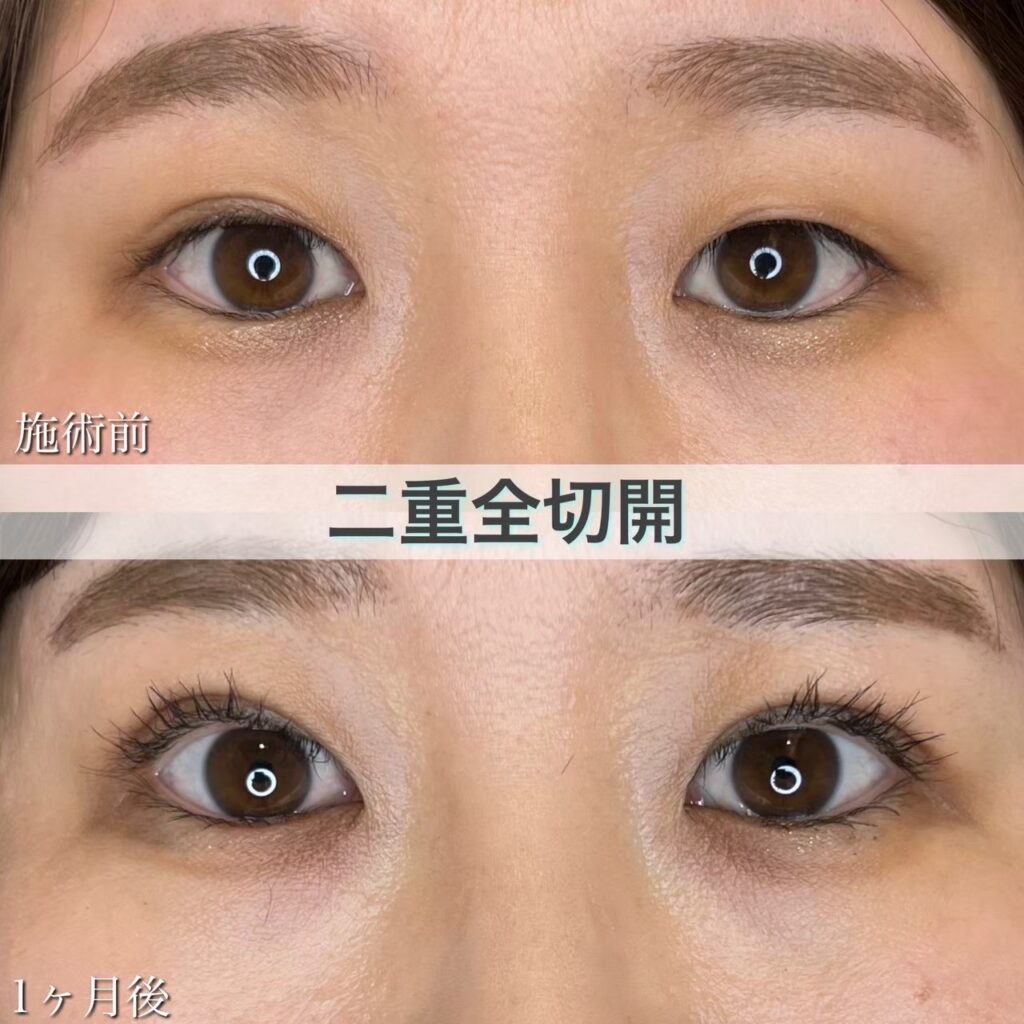 二重全切開の症例