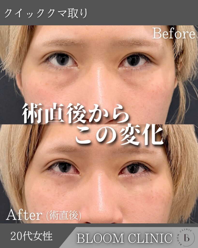 クマ取り（目の下の脂肪取り）の症例