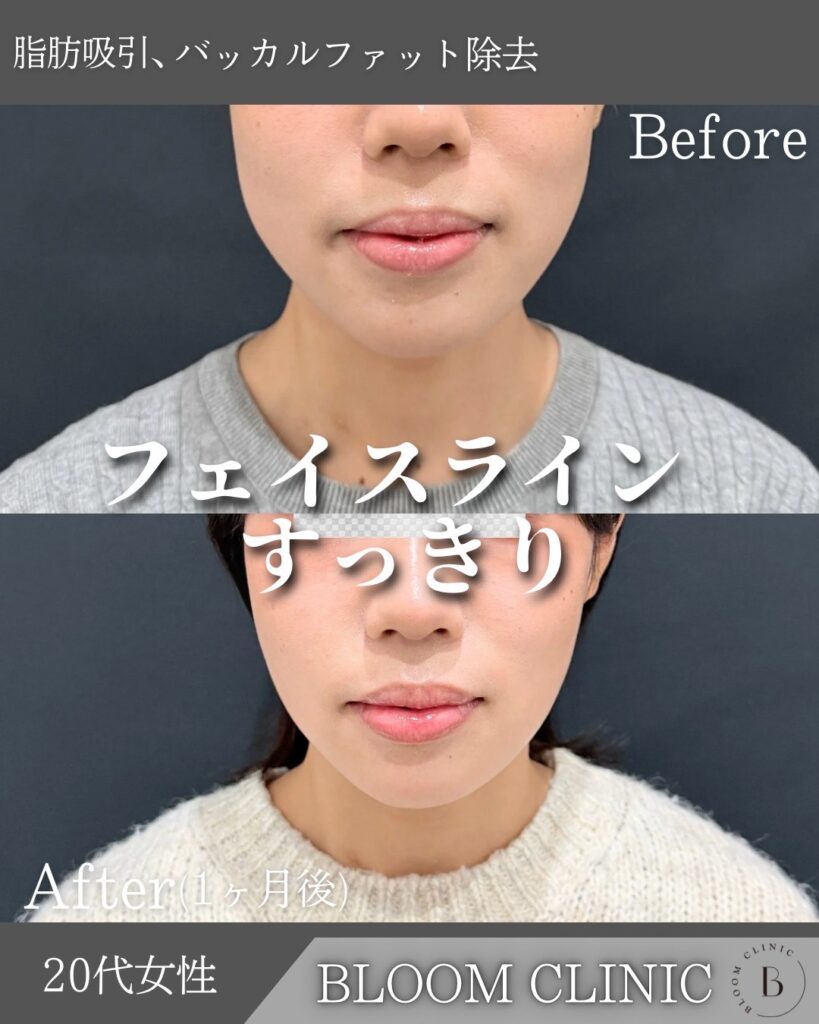 脂肪吸引の症例