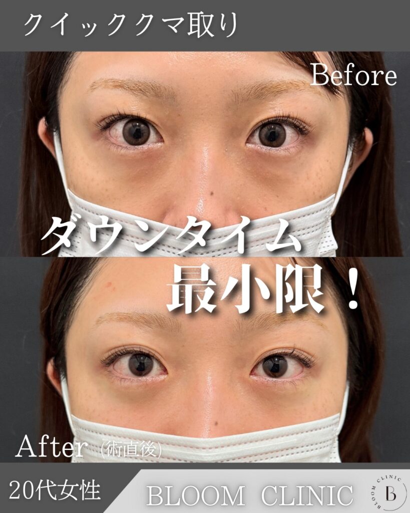 クマ取り（目の下の脂肪取り）の症例