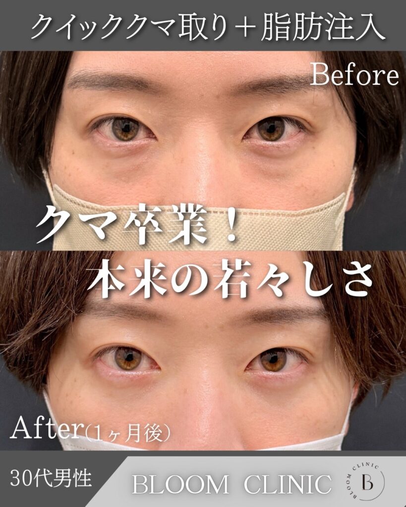 クマ取り＋脂肪注入の症例