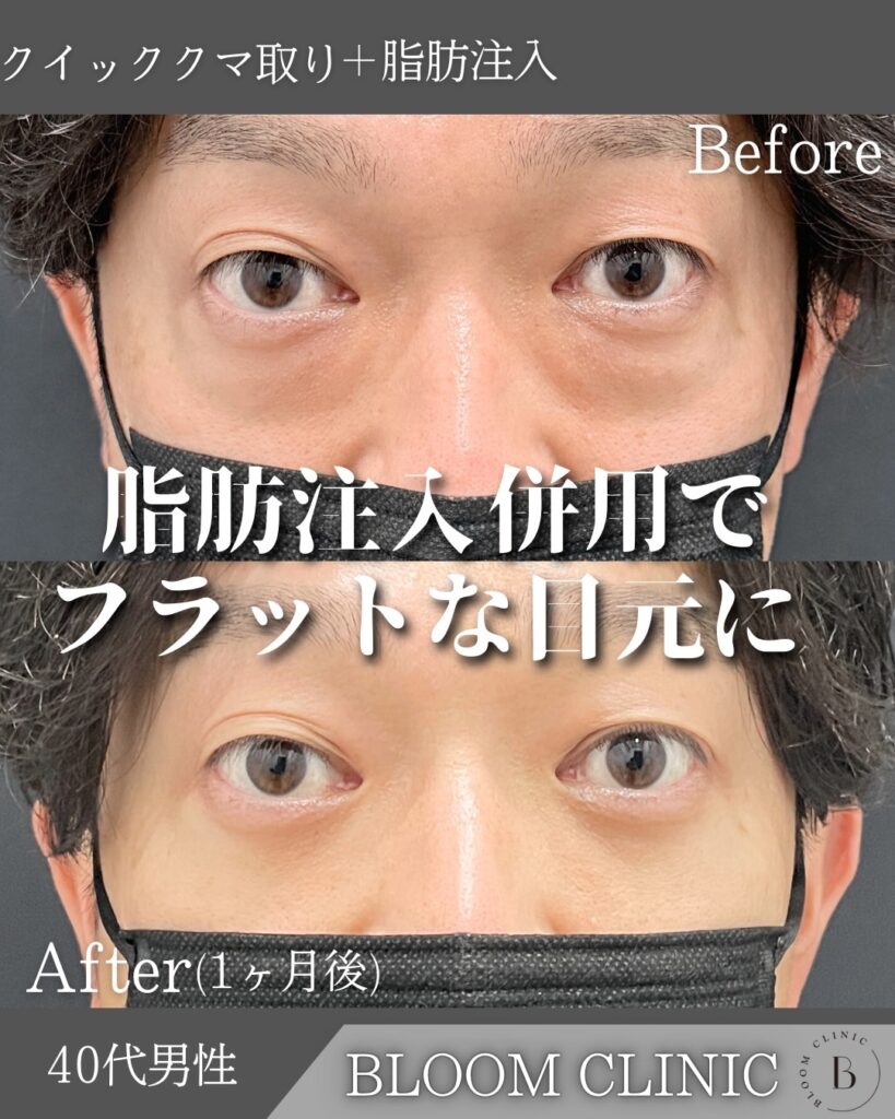 クマ取り＋脂肪注入の症例