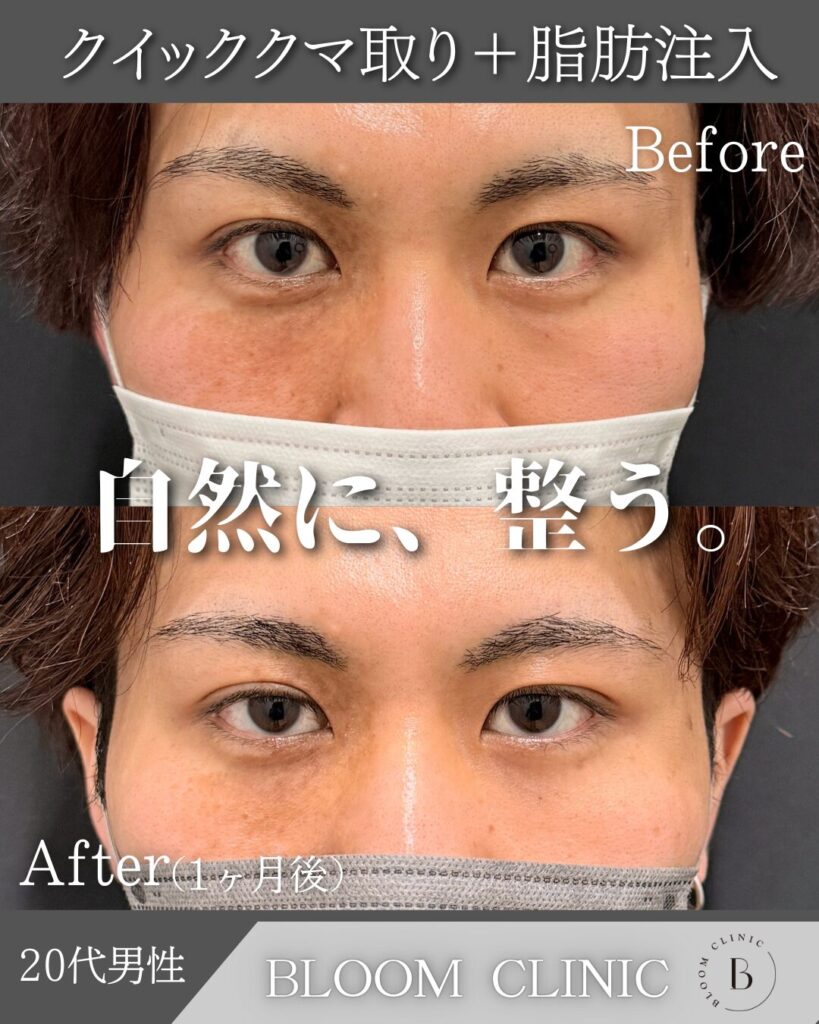 クマ取り＋脂肪注入の症例