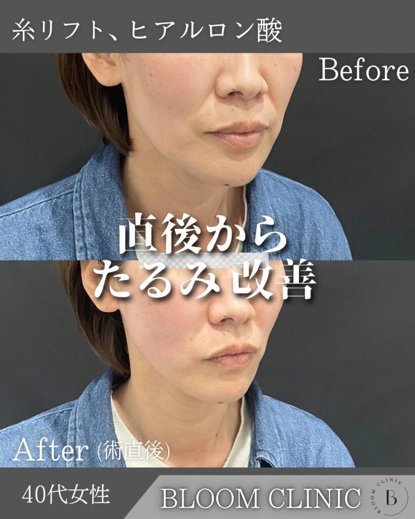 BLOOM　THREAD（糸リフト）・ヒアルロン酸（ほうれい線）の症例
