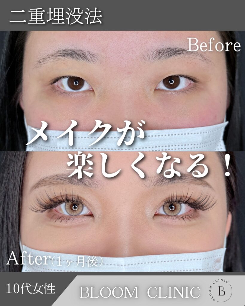 二重埋没法　自然癒着法の症例