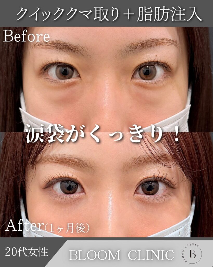 クマ取り＋脂肪注入の症例