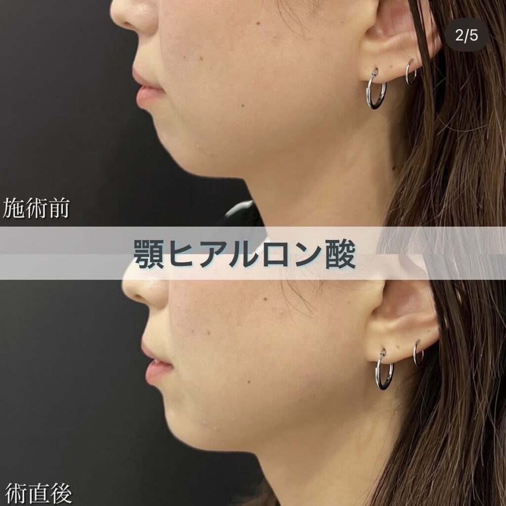 ヒアルロン酸（顎）の症例