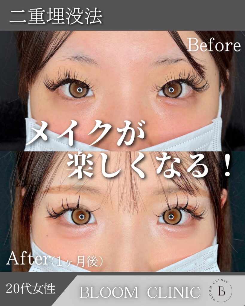 二重埋没法　自然癒着法の症例