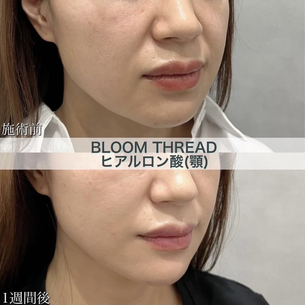 BLOOM　THREAD（糸リフト）・ヒアルロン酸（顎）の症例