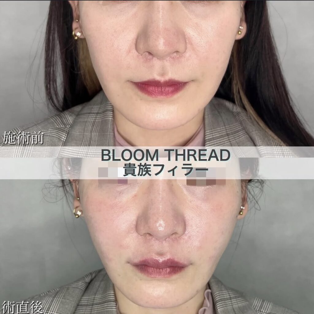 BLOOM　THREAD（糸リフト）・ヒアルロン酸（貴族）の症例