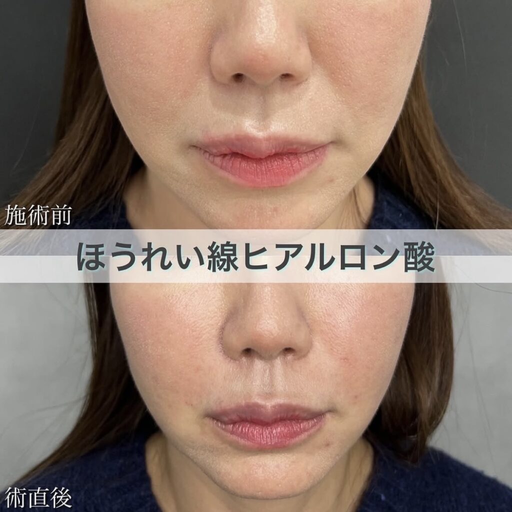 ヒアルロン酸（ほうれい線）の症例
