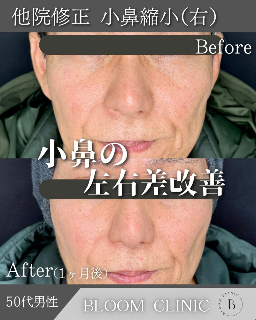 小鼻縮小切開法の症例